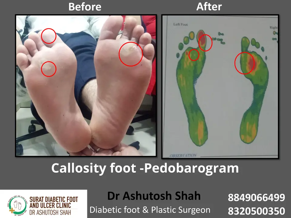 Investigations for Diabetic Foot.pptx-2.webp